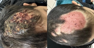 Dermatoloji (Cildiye) Doktoru Ömer Özdemir Yoğun İlgi Görüyor